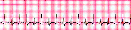 ECG tracing of SVT